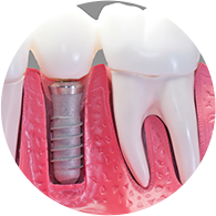 Clinica_DF_-_Blog_-_Implante_dental