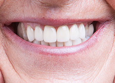 <h1 style="color: #FFFAFA; margin: 31px 0px 15px 0px;"><p class="style_img_title_banner img_title_banner"></p><span>IMPLANTE</span></h1><p class ="slide"> O implante dentário recupera a qualidade de vida e a autoestima do paciente!</p>      <a href="https://www.clinicadf.com.br/tratamentos/implantodontia/" class="btn-banner_saibamais btn_banner_saiba_mais"></a>