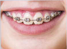 <h1 style="color: #FFFAFA; margin: 31px 0px 15px 0px;"><p class="style_img_title_banner img_title_banner"></p><span>ORTODONTIA</span></h1><p class ="slide"> Quem nunca sonhou com dentes alinhados e bem posicionados?</p>    <a href="https://www.clinicadf.com.br/tratamentos/ortodontia/" class="btn-banner_saibamais btn_banner_saiba_mais"></a>